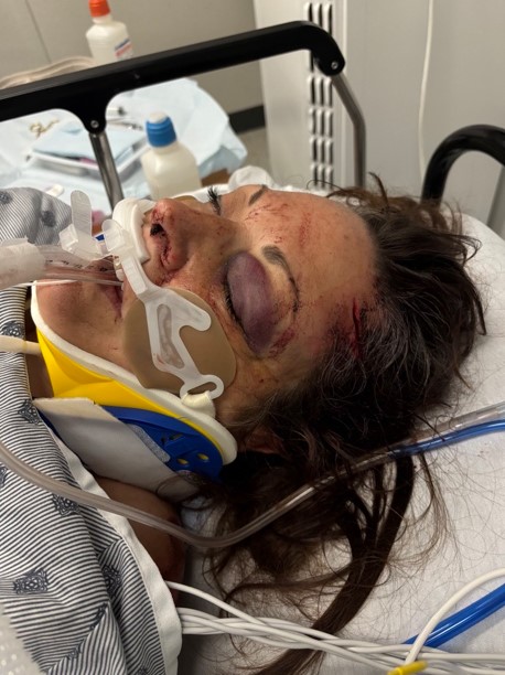 Montreal cyclist says ‘miracle’ she’s alive after hitting pothole, goes into coma