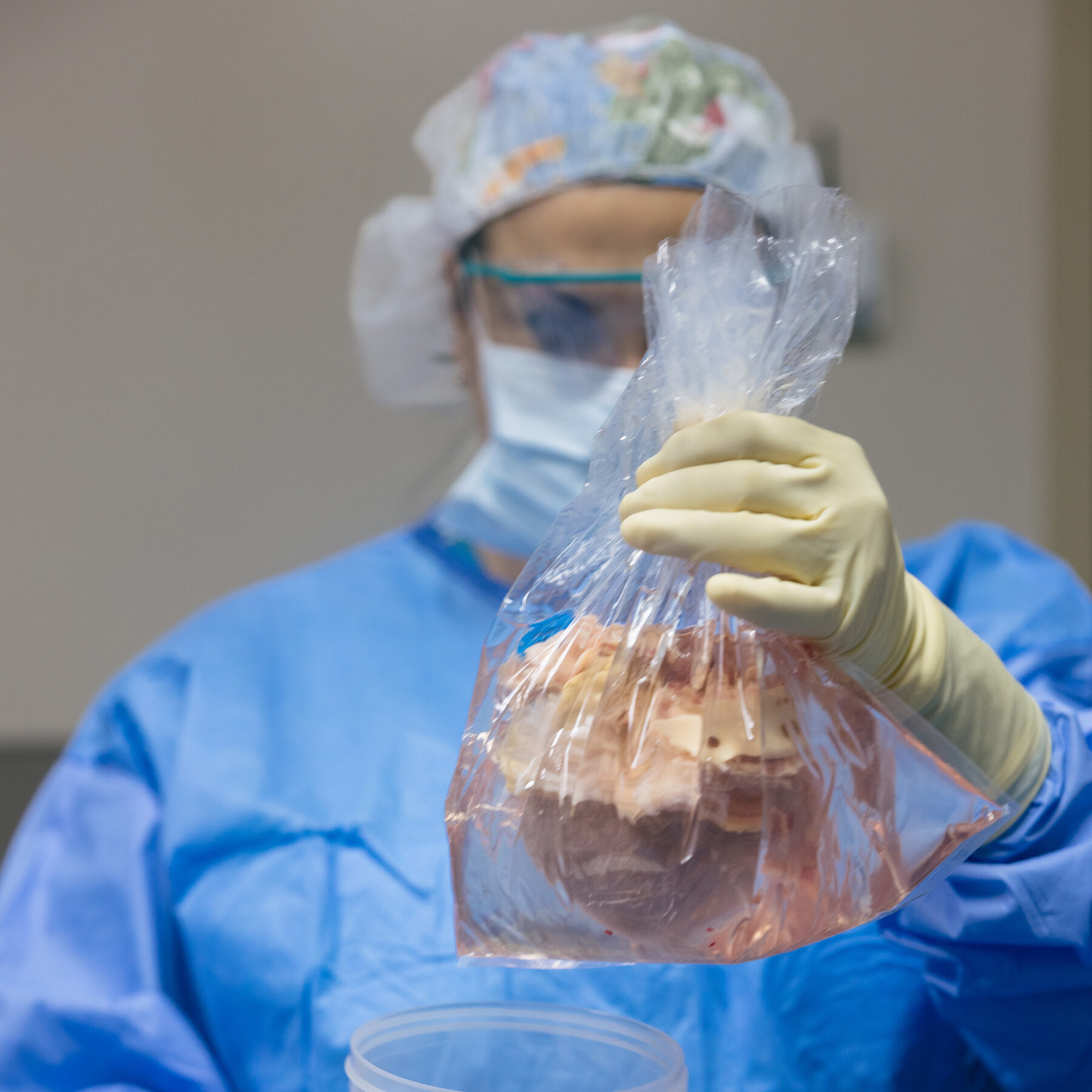 U.S. Transplant Hospitals Court Patients Overseas Despite Organ Shortage