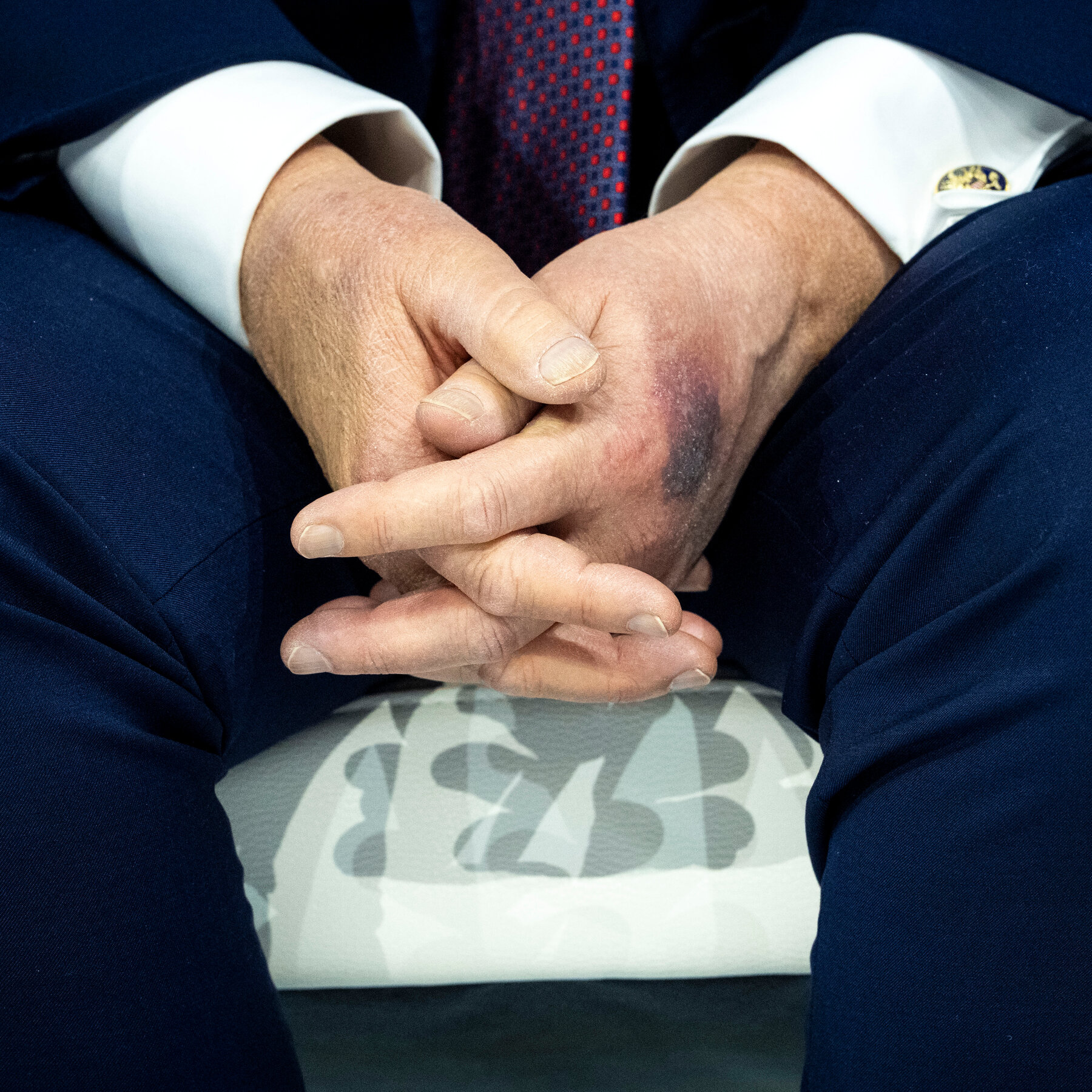 Trump Says He Bruised His Hand on a Table