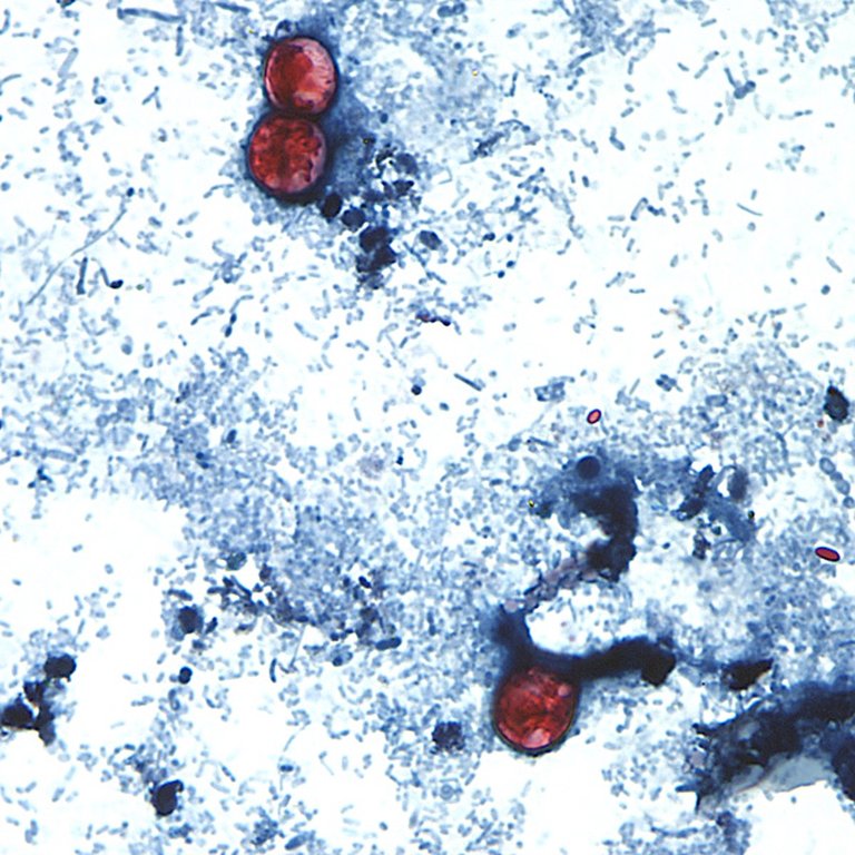 Where cyclosporiasis cases stand in Canada as U.S. parasite outbreak rages